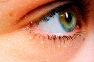 kuidas eemaldada rasvapallid silmade all